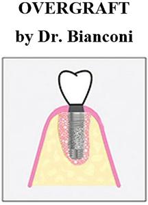 OVERGRAFT by Dr. Bianconi - לוגו סימן מסחר רשום
